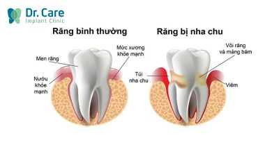 Viêm nha chu có gây mất răng không?